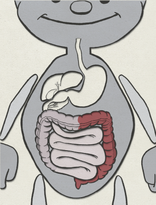 Entzündungsverlauf bei Colitis ulcerosa. Dabei befindet sich die Entzündung ausschließlich Dickdarms.
