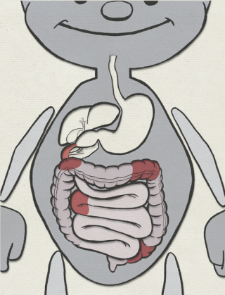Entzündungsverlauf bei Morbus crohn. Hier sind die Entzündungen im Magen-Darm-Bereich verstreut.